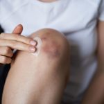 5 Cara Menyembuhkan Memar di Sekitar Lutut dengan Cepat