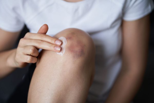 5 Cara Menyembuhkan Memar di Sekitar Lutut dengan Cepat 5 Cara Menyembuhkan Memar di Sekitar Lutut dengan Cepat