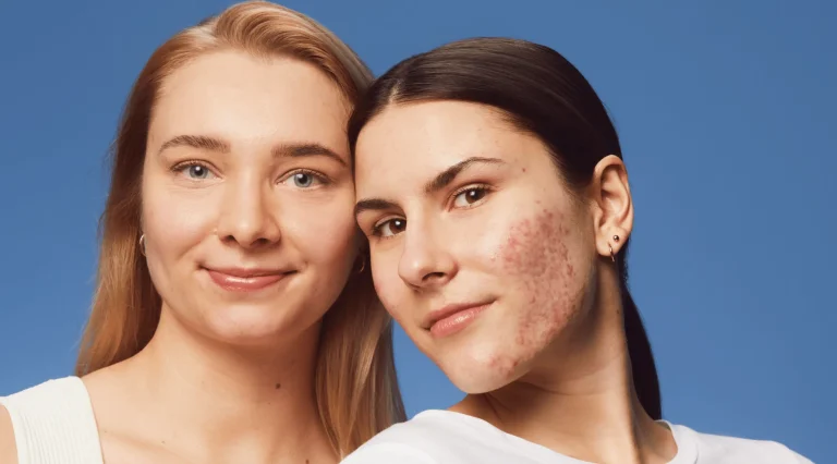 7 Cara Detoks Kulit dari Dalam agar Jerawat Cepat Hilang